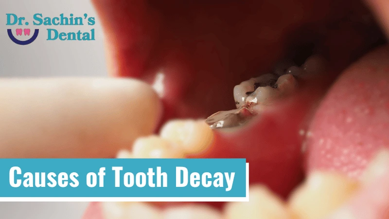 Causes of Tooth Decay