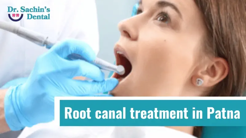 Root canal treatment in Patna