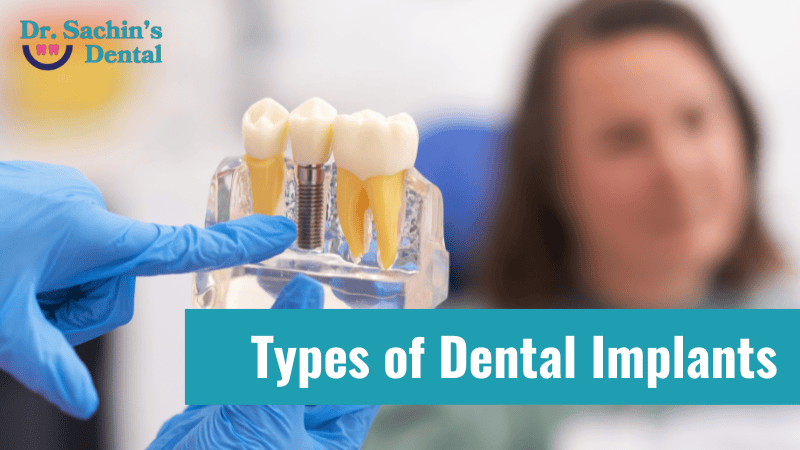 types of dental implants