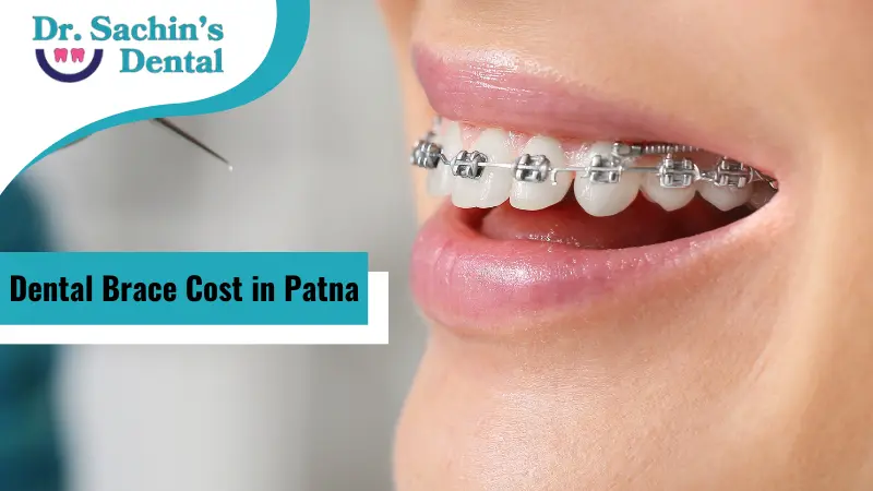 Dental Brace Cost in Patna