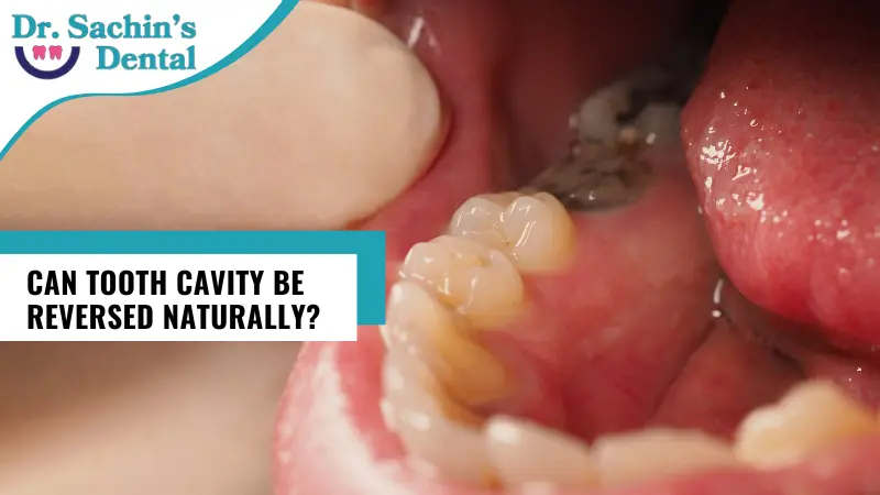Can Tooth Cavity Be Reversed Naturally