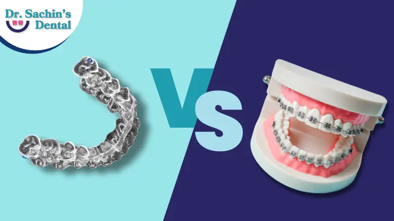 Clear Aligners vs Traditional Braces