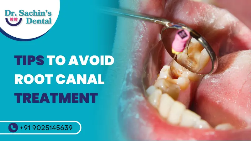 Tips to Avoid Root Canal Treatment