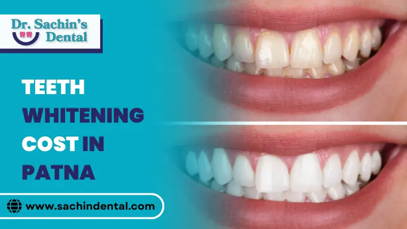 teeth whitening cost in Patna