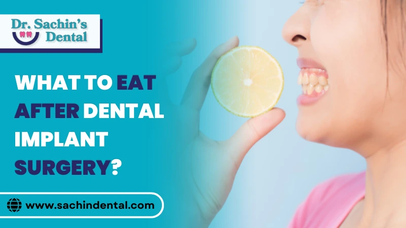 What to Eat After Dental Implant Surgery