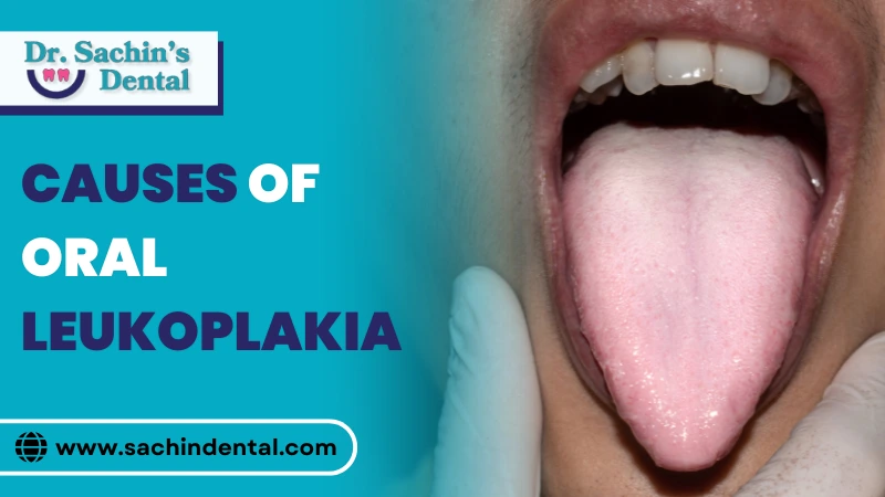 Causes of oral leukoplakia