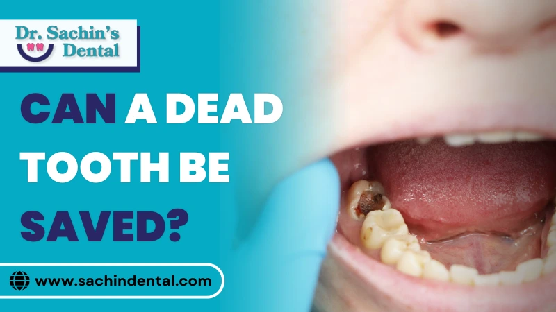 Can a Dead Tooth Be Saved?