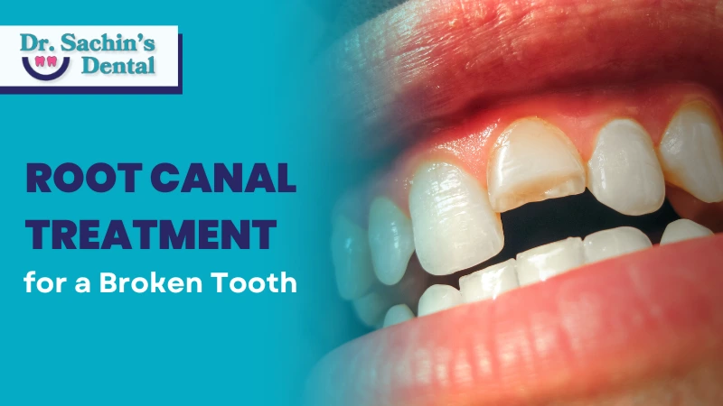 Root canal treatment for a broken tooth