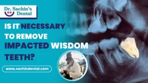 is it necessary to remove impacted wisdom teeth