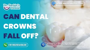 Can Dental Crowns Fall Off