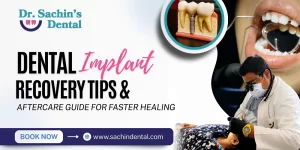 Dental Implant Recovery Tips