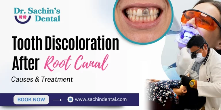 Tooth Discoloration After Root Canal
